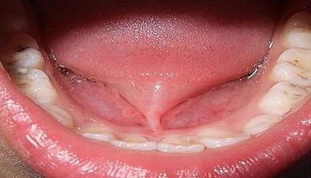 唇系带延长术