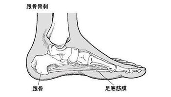 足跟骨刺