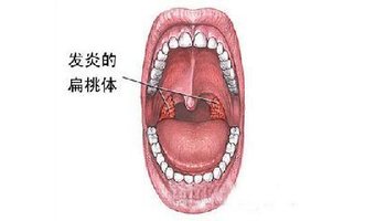 舌根部淋巴滤泡增生慢性咽炎的表现,中医又叫"梅核气",就是咽喉部的