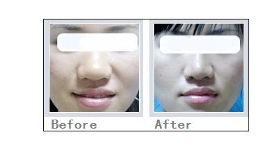 鼻头缩小手术|缩鼻头手术